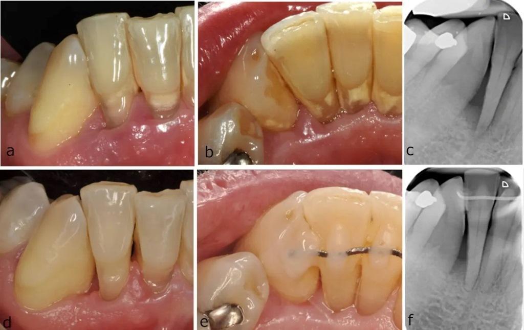 Research shows that MINST is effective for intraosseous defects1