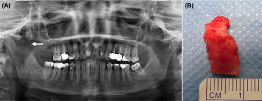 Injection of local anesthesia led to rare ossification of the temporalis muscle2 