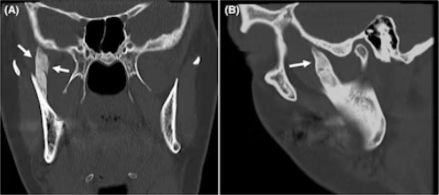 Injection of local anesthesia led to rare ossification of the temporal muscle1