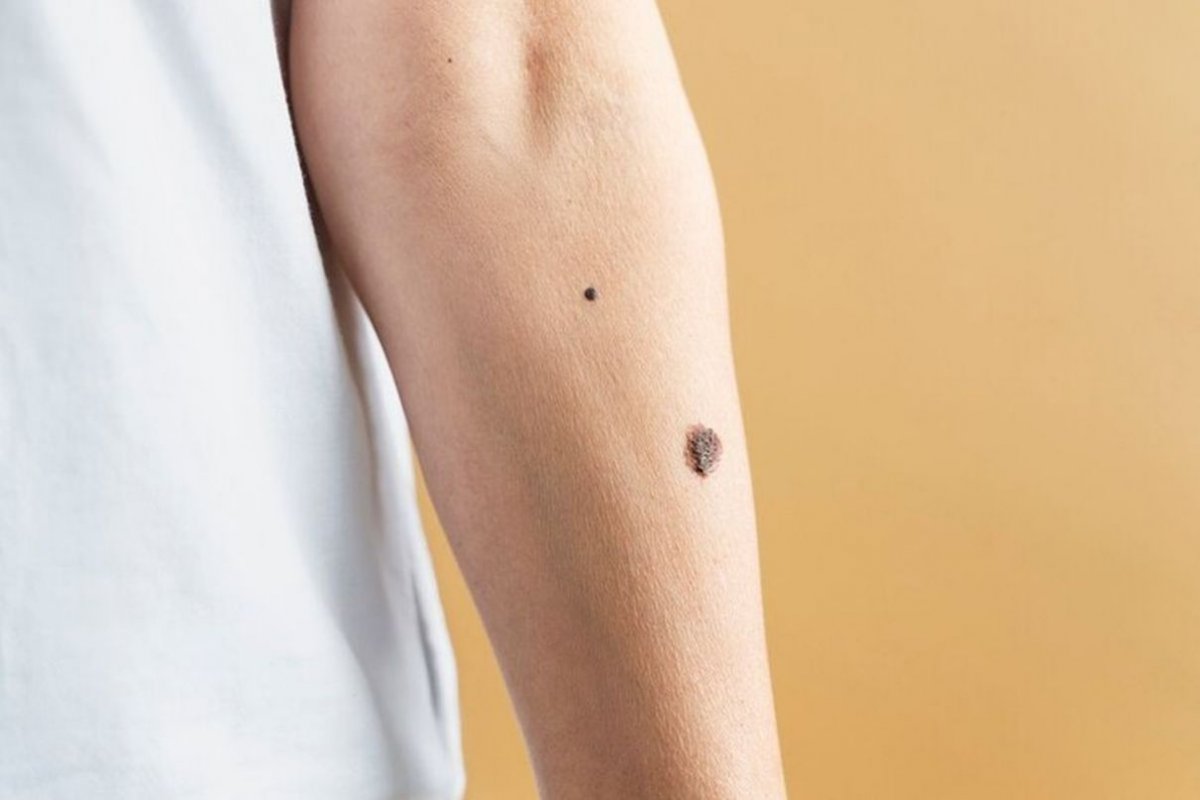 large mole on the arm