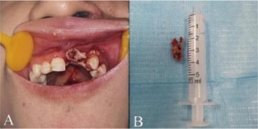 Shingles Causes 29-Year-Old Man to Lose 6 Teeth in a Rapid Way3