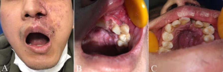 Shingles Caused Rapid Loss of 6 Teeth in a 29-Year-Old Man1