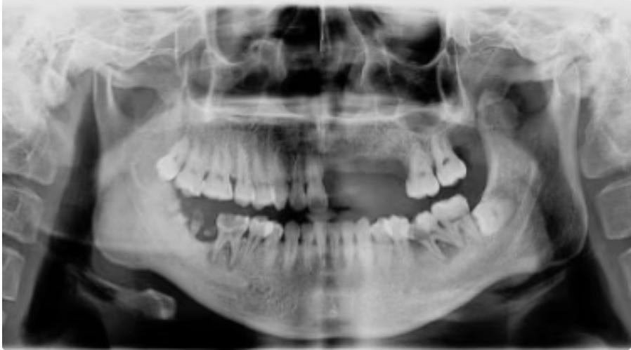 Shingles Causes Rapid Loss of 6 Teeth in 29-Year-Old Man2