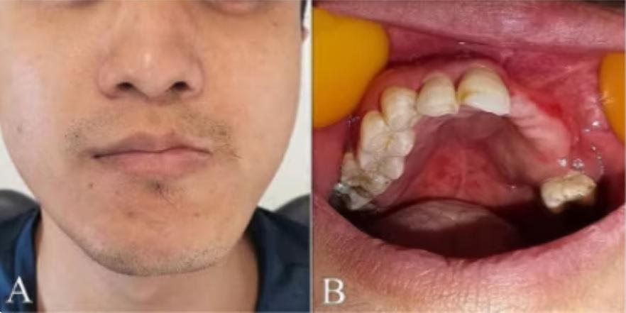 Shingles Causes Rapid Loss of 6 Teeth in 29-Year-Old Man4