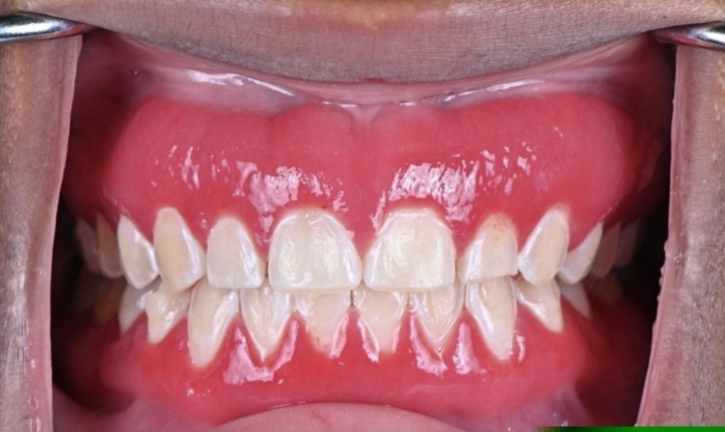 Plasma cell gingivitis: clinical and pathological case 1