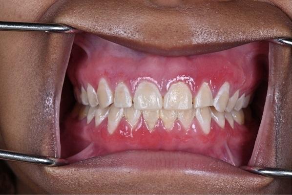 Plasma cell gingivitis: a clinical and pathological case