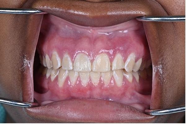 Plasma cell gingivitis: clinical and pathological case5