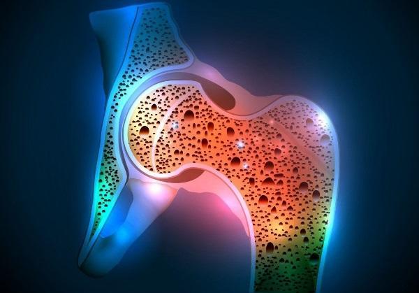 Risk of osteoporosis can be determined by the mouth