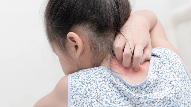 Eczema in children can provoke depression and isolation