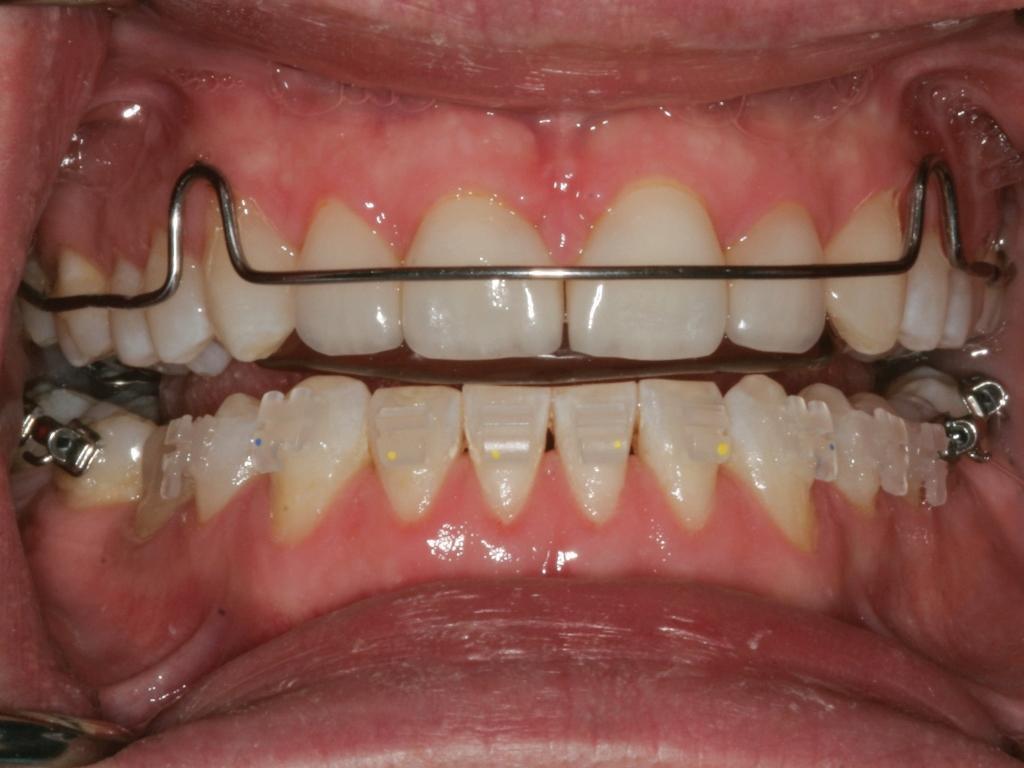 Sleep Disordered Breathing and Its Potential Impact in the Field of Restorative Dentistry (A 14-Year Case Study)8