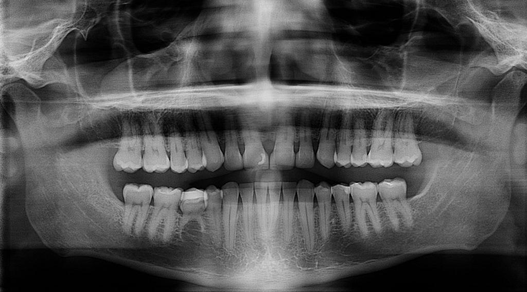 Sleep Disordered Breathing and Its Potential Impact in the Field of Restorative Dentistry (14-Year Case Study)13