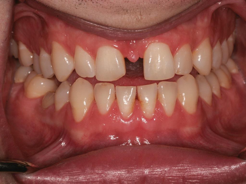 Sleep Disordered Breathing and Its Potential Impact in the Field of Therapeutic Dentistry (A 14-Year Case Study)3