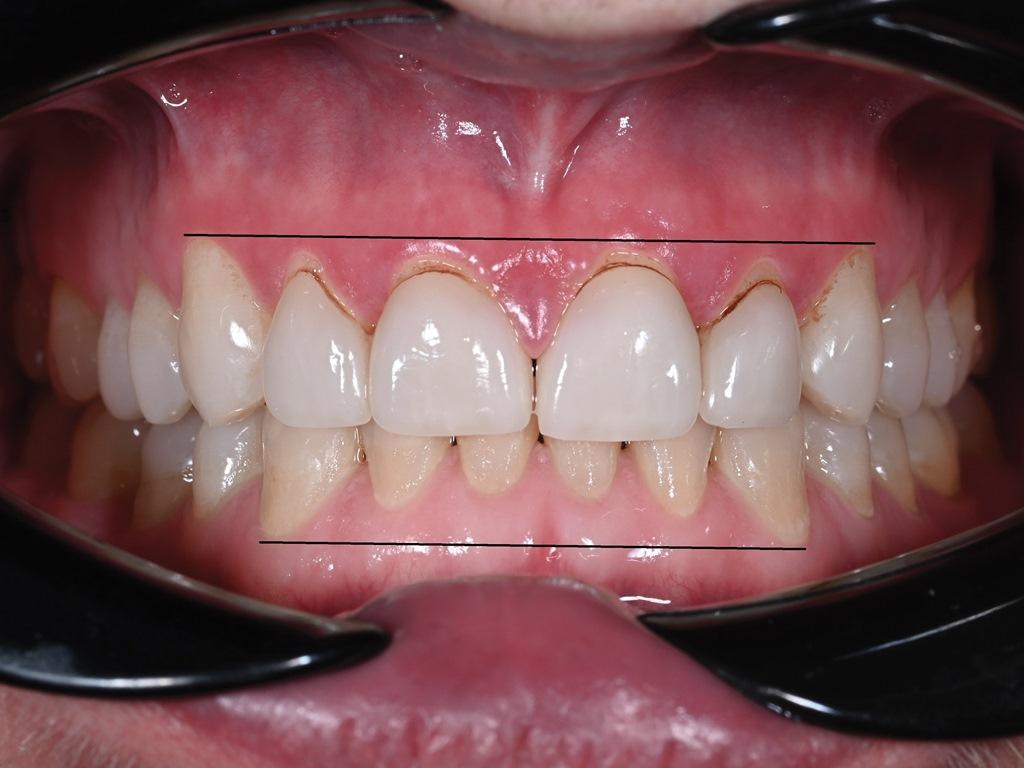 Sleep Disordered Breathing and Its Potential Impact in the Field of Restorative Dentistry (A 14-Year Case Study)12