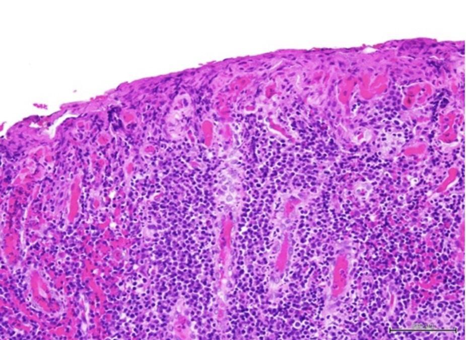 Plasma cell gingivitis: clinical and pathological case 2